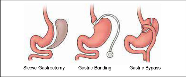 Gastric Bypass, LAP-BAND Surgery and Gastric Sleeves